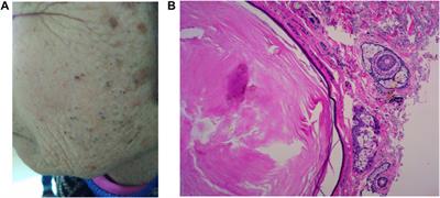 Aging in the sebaceous gland